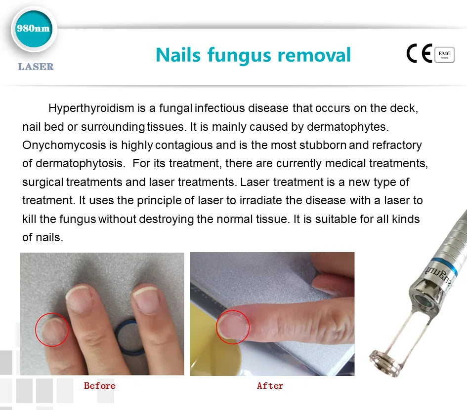 5 In 1 980nm Diode Laser, Nail Fungus, Spider Veins
