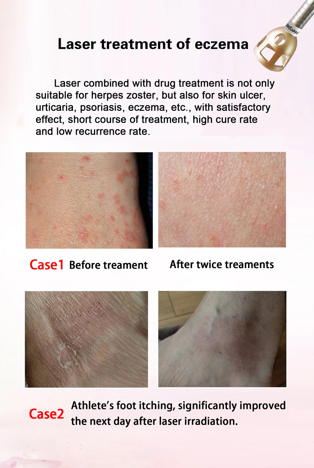 5 In 1 980nm Diode Laser, Nail Fungus, Spider Veins