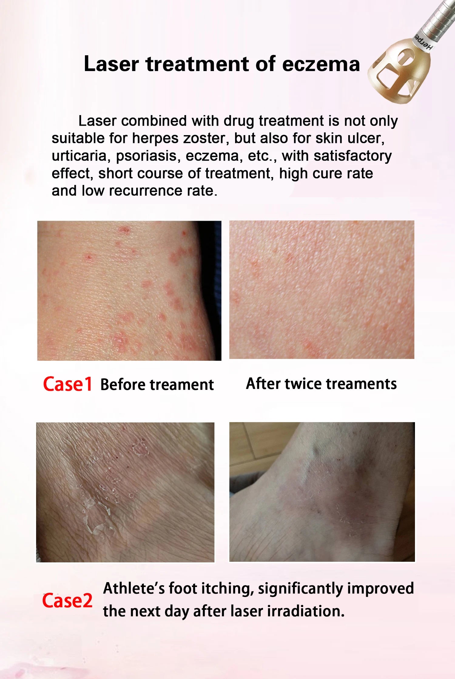 5 In 1 980nm Diode Laser, Nail Fungus, Spider Veins